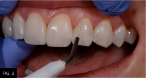 gingival sculpting Bluewave diode laser