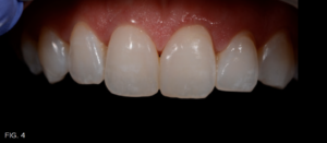 symmetric gingival laser surgery