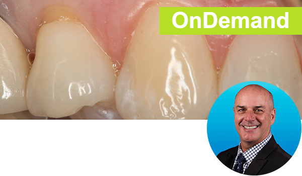 Beautiful Class V Restorations: Predictable and Simplified Course