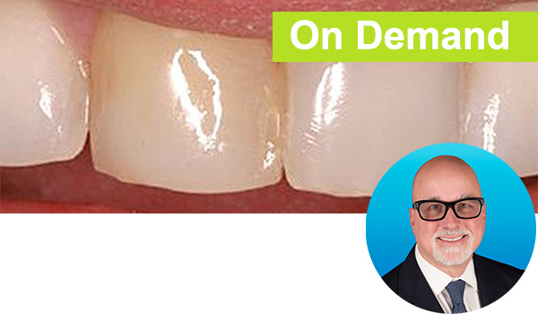 Restoring the Discolored Central Incisor Course