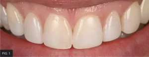 pre-operative smile anterior