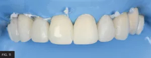 every tooth in arch mesially inclined