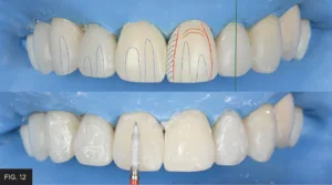 depressions and elevations of adjacent teeth replicated