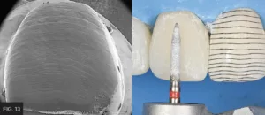 imparting texture with lines crossing enamel surface