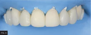 direct veneer buildup