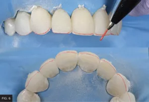 pencil mark inciso-facial line angles contours