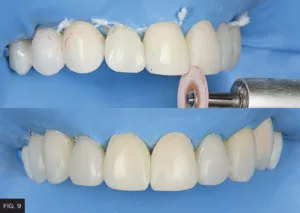 four embrasure surfaces contoured