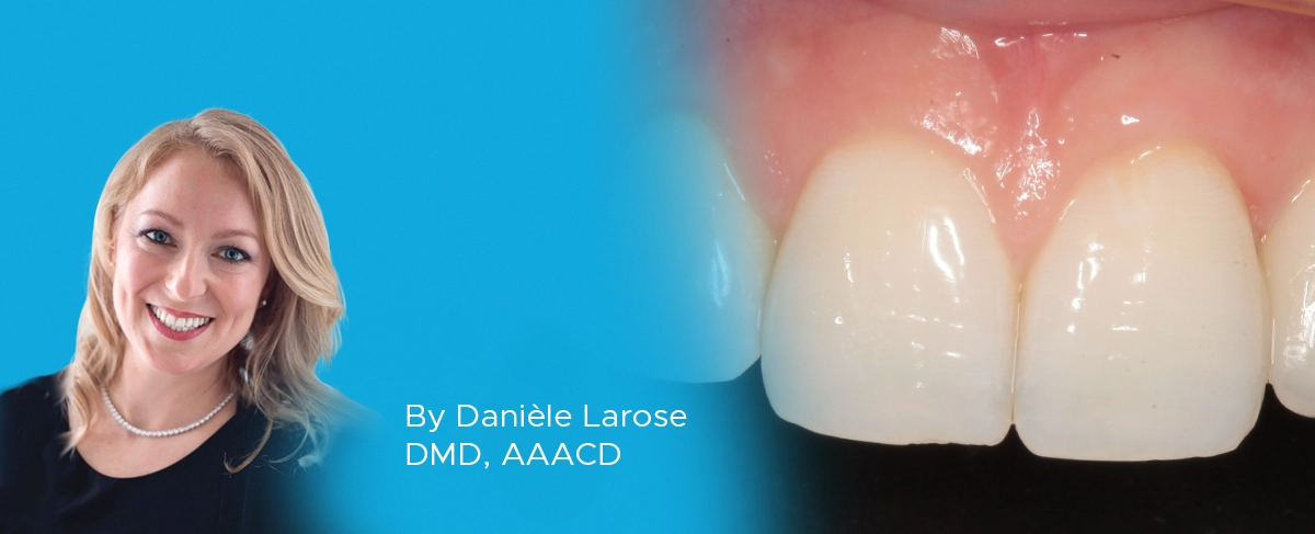 Dr. Larose article Missing Tooth banner