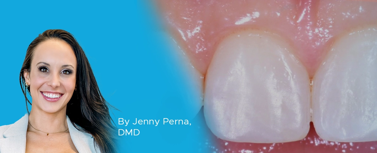 Perna Protocol Class IV Restorations