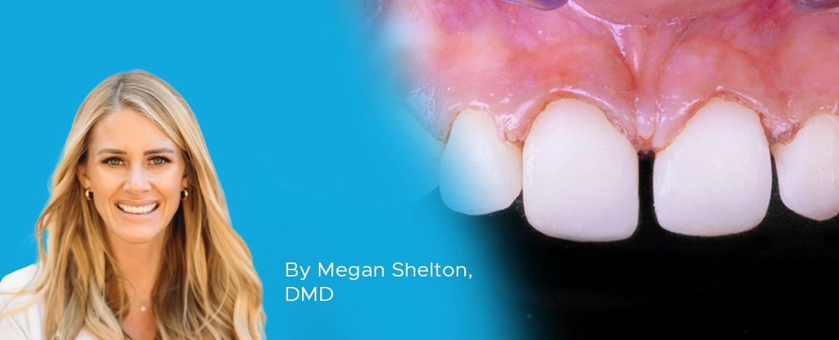 Dr Shelton injection molding composite veneers article banner