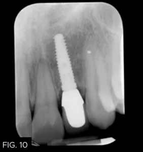 periapical x-ray after treatment