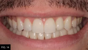 post-op frontal smile view