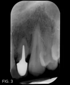 pre-op radiograph