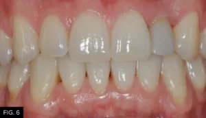 tissue shaping with temporary restoration