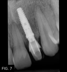 radiograph temporary crown on implant