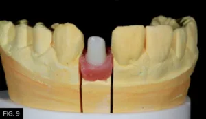 zirconia abutment soft tissue model