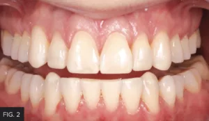 intraoral mock-up, maxillary incisors, maaxillary and mandibular canines