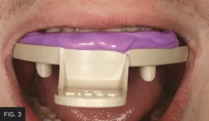 lingual matrix, intraoral composite mock-up