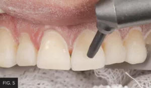 removal aprismatic enamel