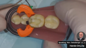 DualForce™ Ring Placement with Marc Geissberger, DDS, MA - Video