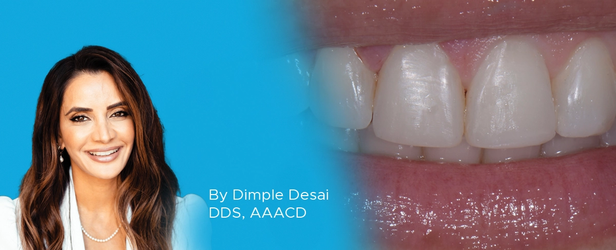 Dr. Dimple Desai Smile Enhancemnt article banner