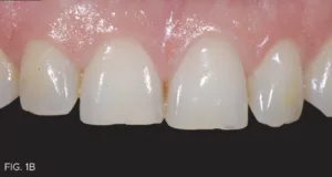 moderate maxillary incisal wear