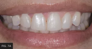 veneer restoration, after smile