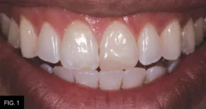 pre-op non ideal restoration tooth #9