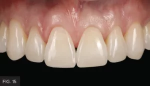 post-op natural form, function, esthetic, restored worn dentition