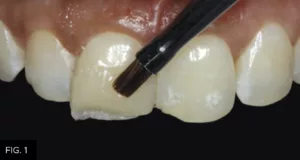 adapt composite with blending resin