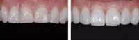 restoration, clinical, Evanesce, before & after