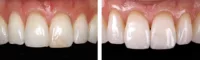 restoration, clinical, Evanesce, before & after