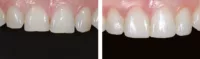 restoration, clinical, Evanesce, before & after