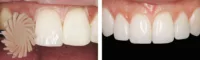 restoration, clinical, Evanesce, before & after