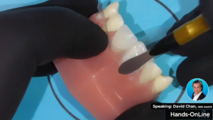 Anterior Composite Pull Through Technique with David Chan, DMD, AAACD - Video