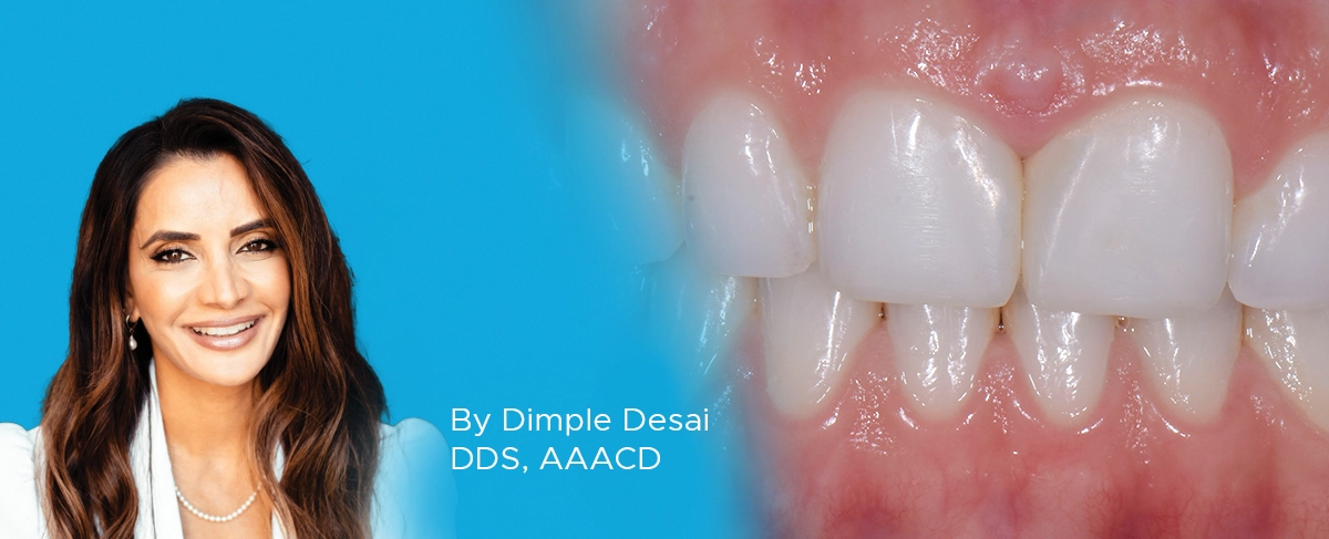 Midline Diastema Clinical Article banner