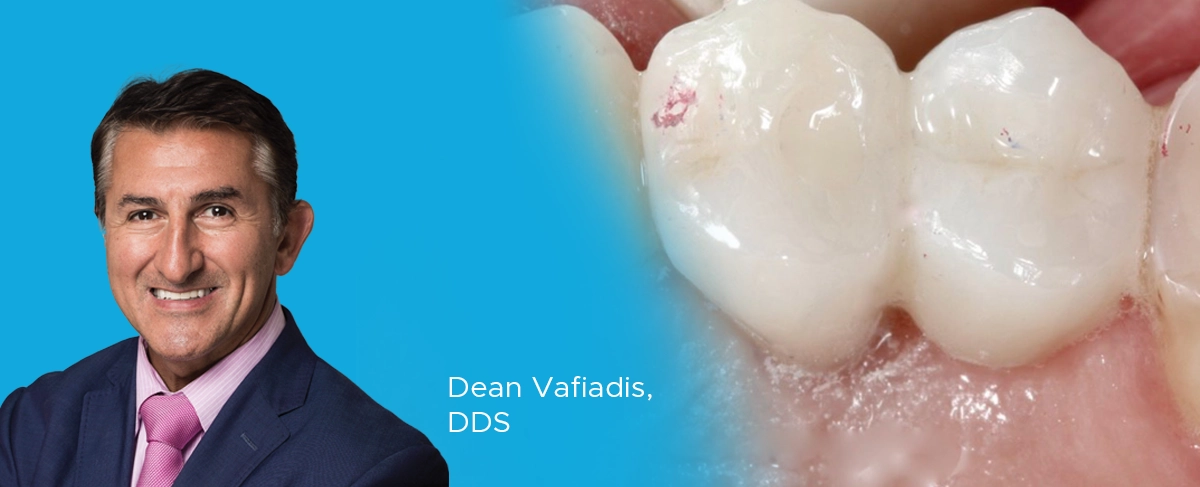 Dr. Vafiadia, zirconia restorations article banner