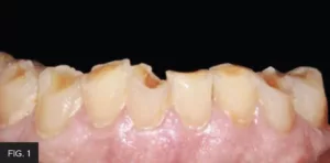 worn/broken lower dentition