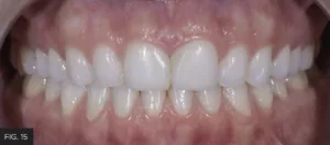 restoration, tooth #8 #9, esthetic