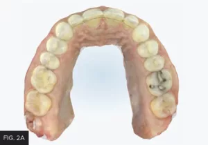 align technology, maxillary scan