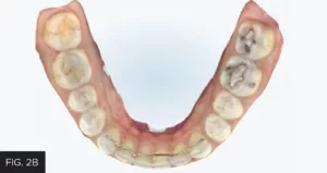 align technology, mandibular scan