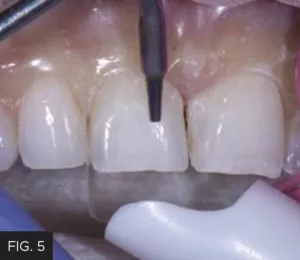 air-abrasion, remove unwanted tooth, composite debris