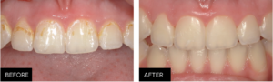 restorative clinical, before & after