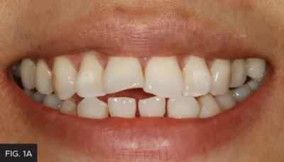 Malalignment oanterior teeth, arch discrepancies