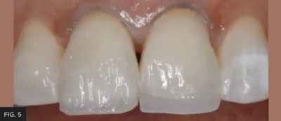 Evanesce B1D dentin layer composite tooth #8