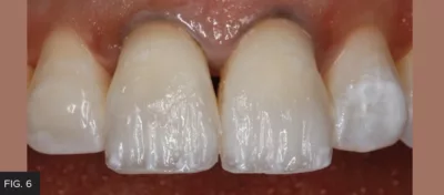 dentin placement composite tooth #9