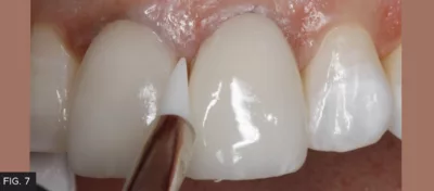 enamel layer, gingival margin, incisal edge