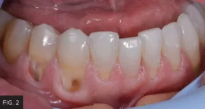 decay removed up to free gingival margin