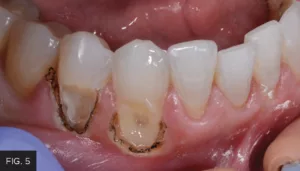 retraction paste, tooth prep