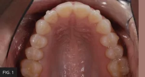 pre-op, food trap, decay mesial of #13